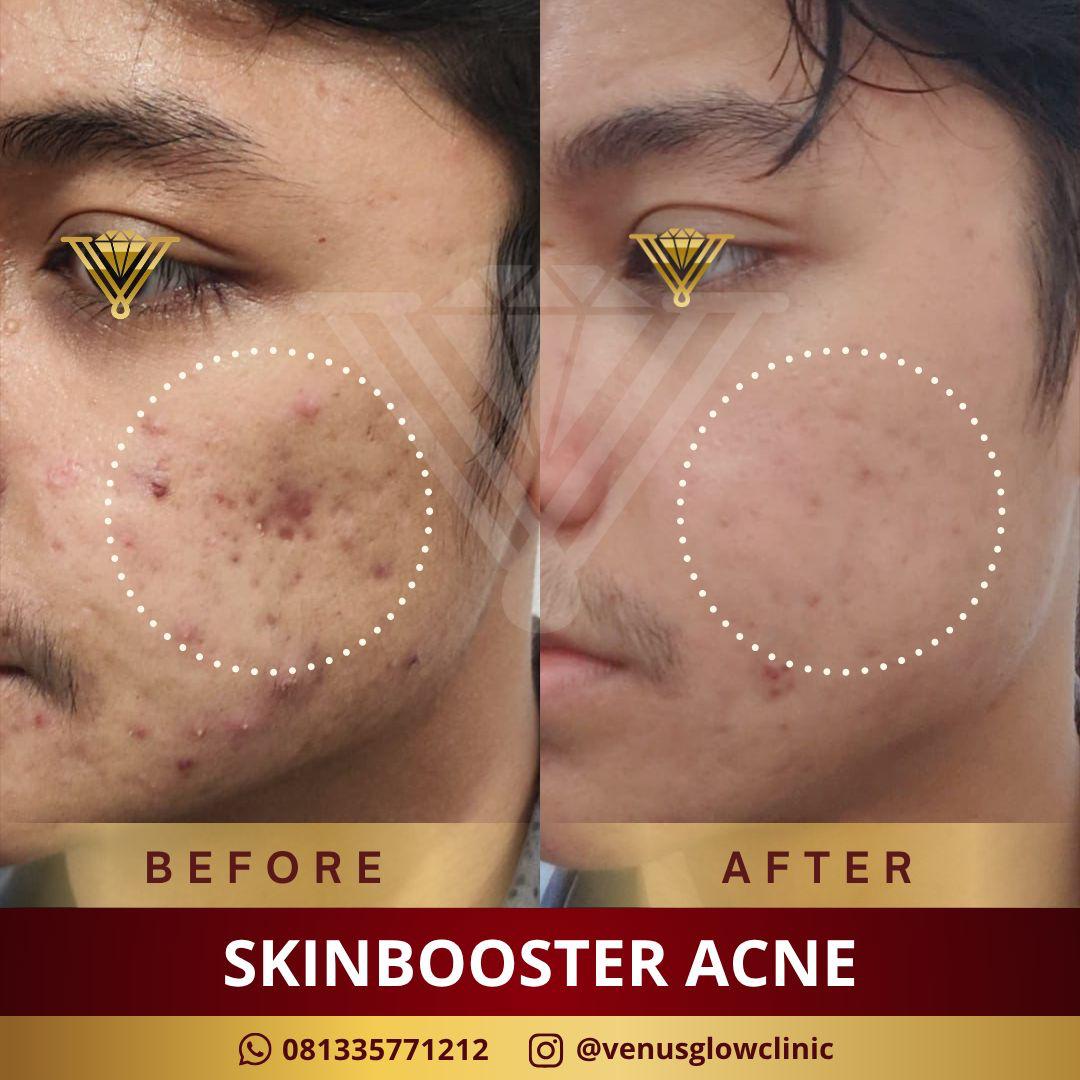 Before & after Skinbooster Acne — pasien Venus Glow