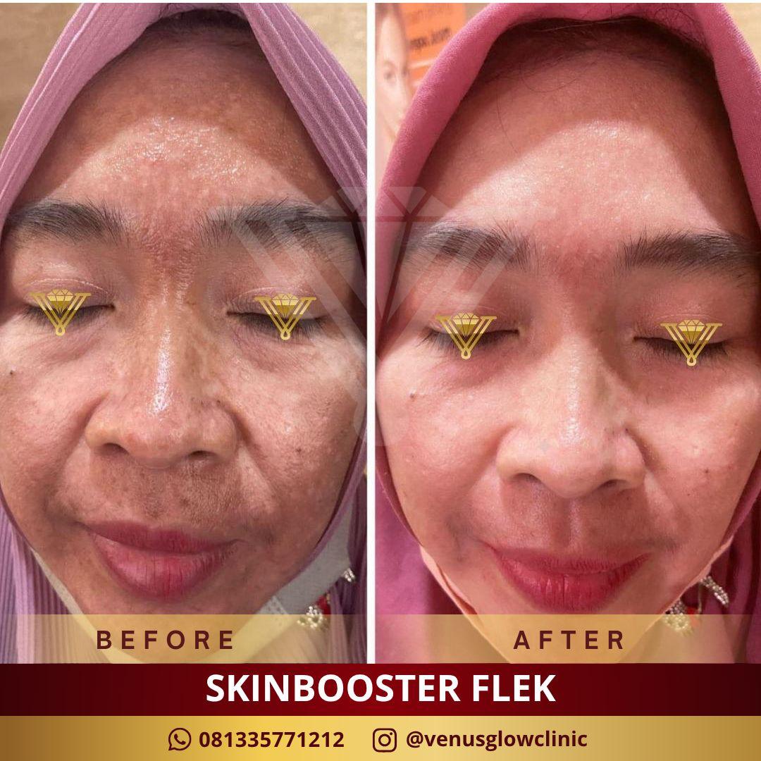 Before & after Skinbooster Flek — pasien Venus Glow