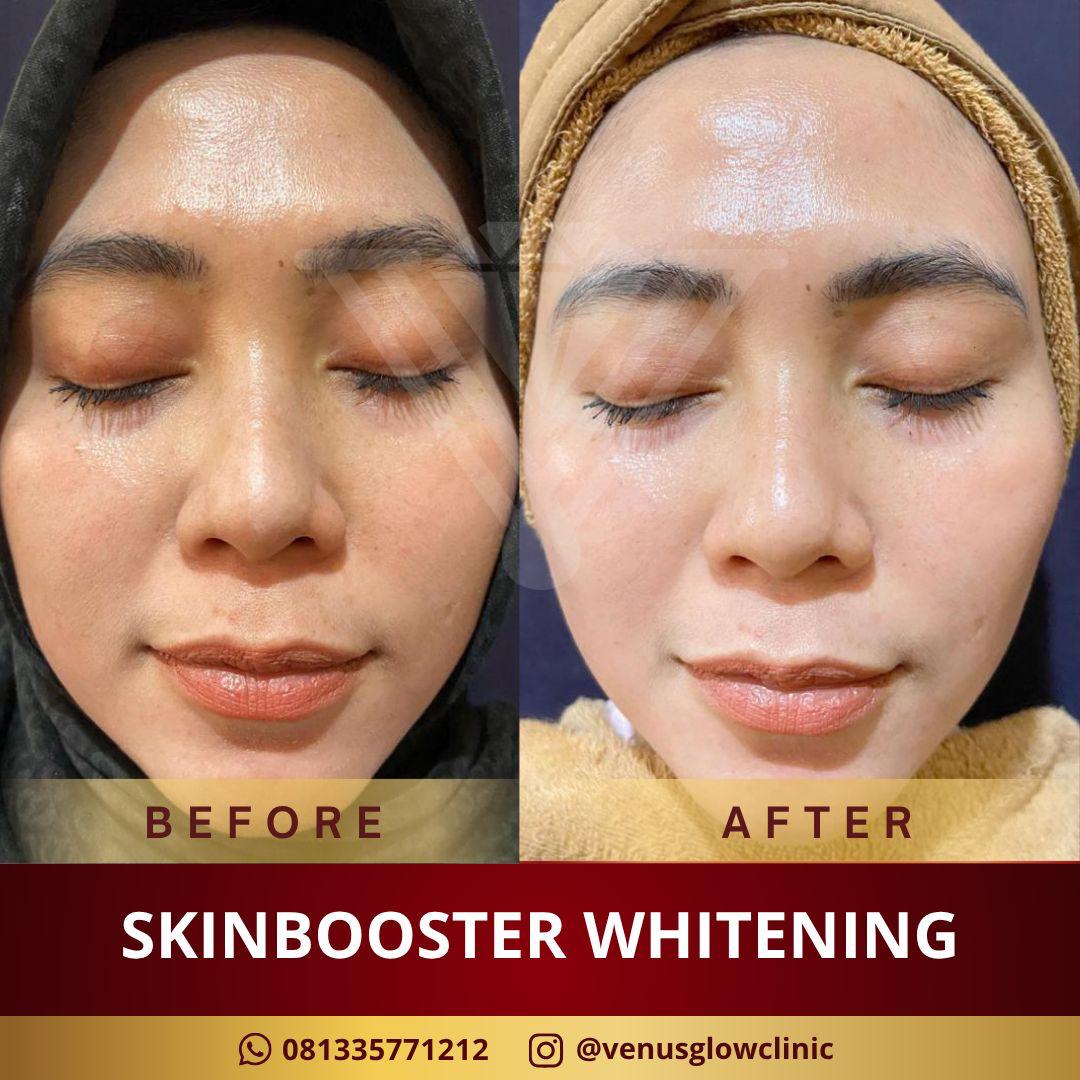 Before & after Skinbooster Whitening — pasien Venus Glow
