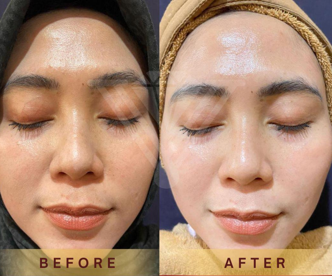 Before after Skin Booster Glass Skin — pasien Venus Glow