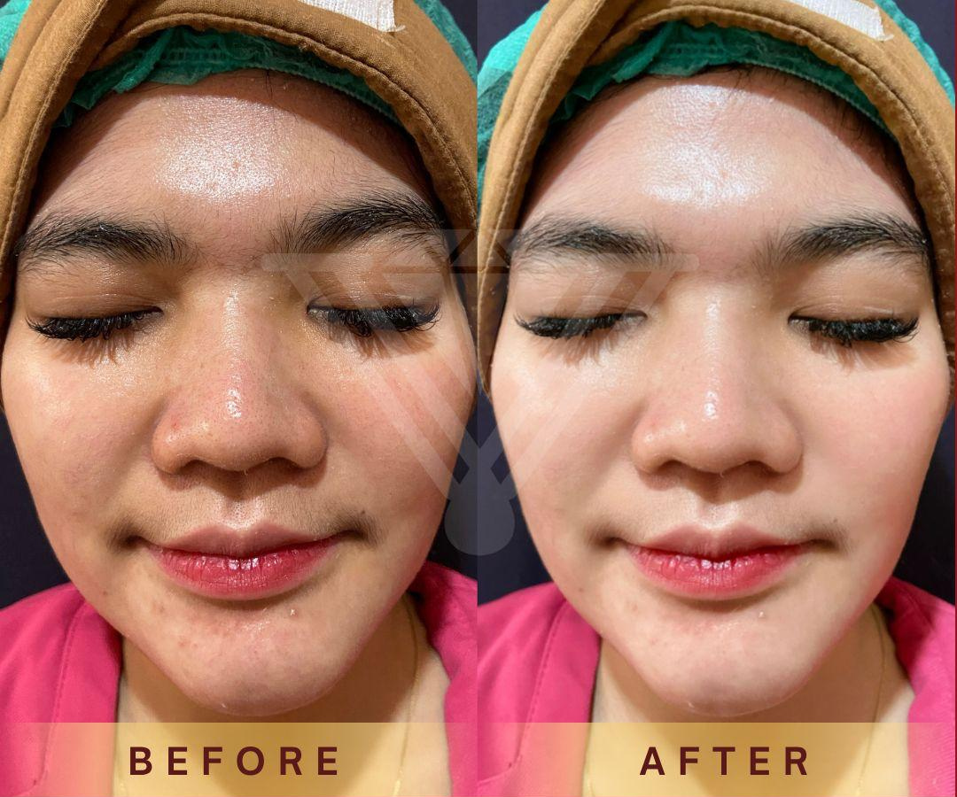 Before after Skin Booster pasien Venus Glow