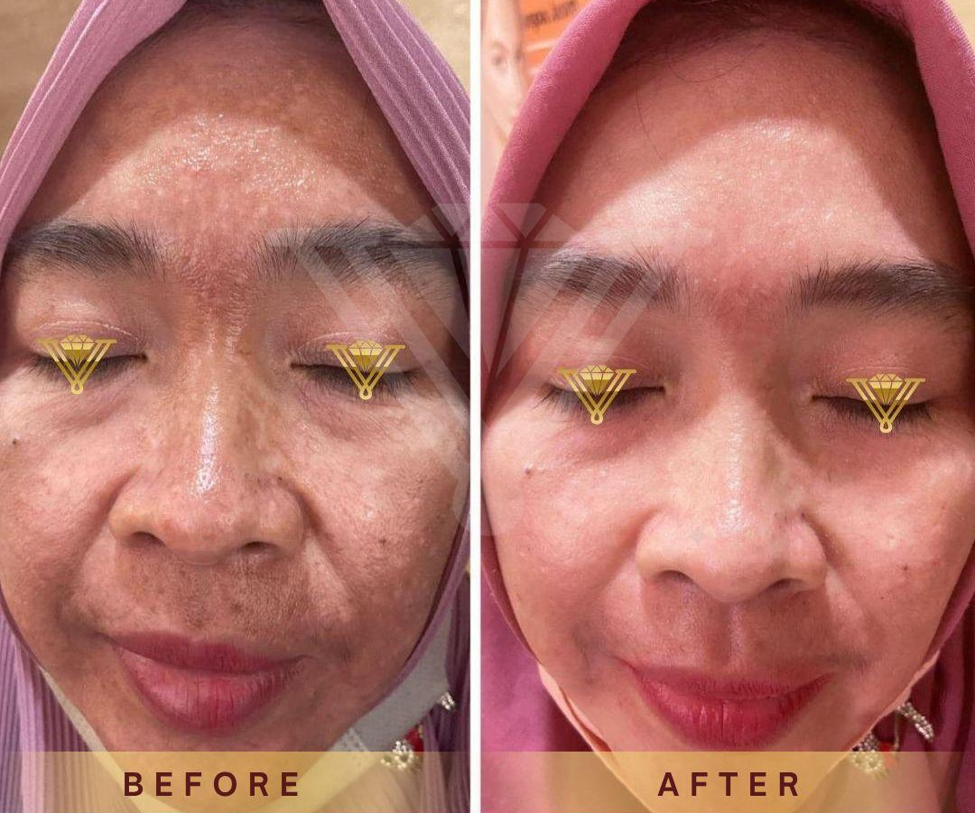 Before after Skin Booster pasien Venus Glow