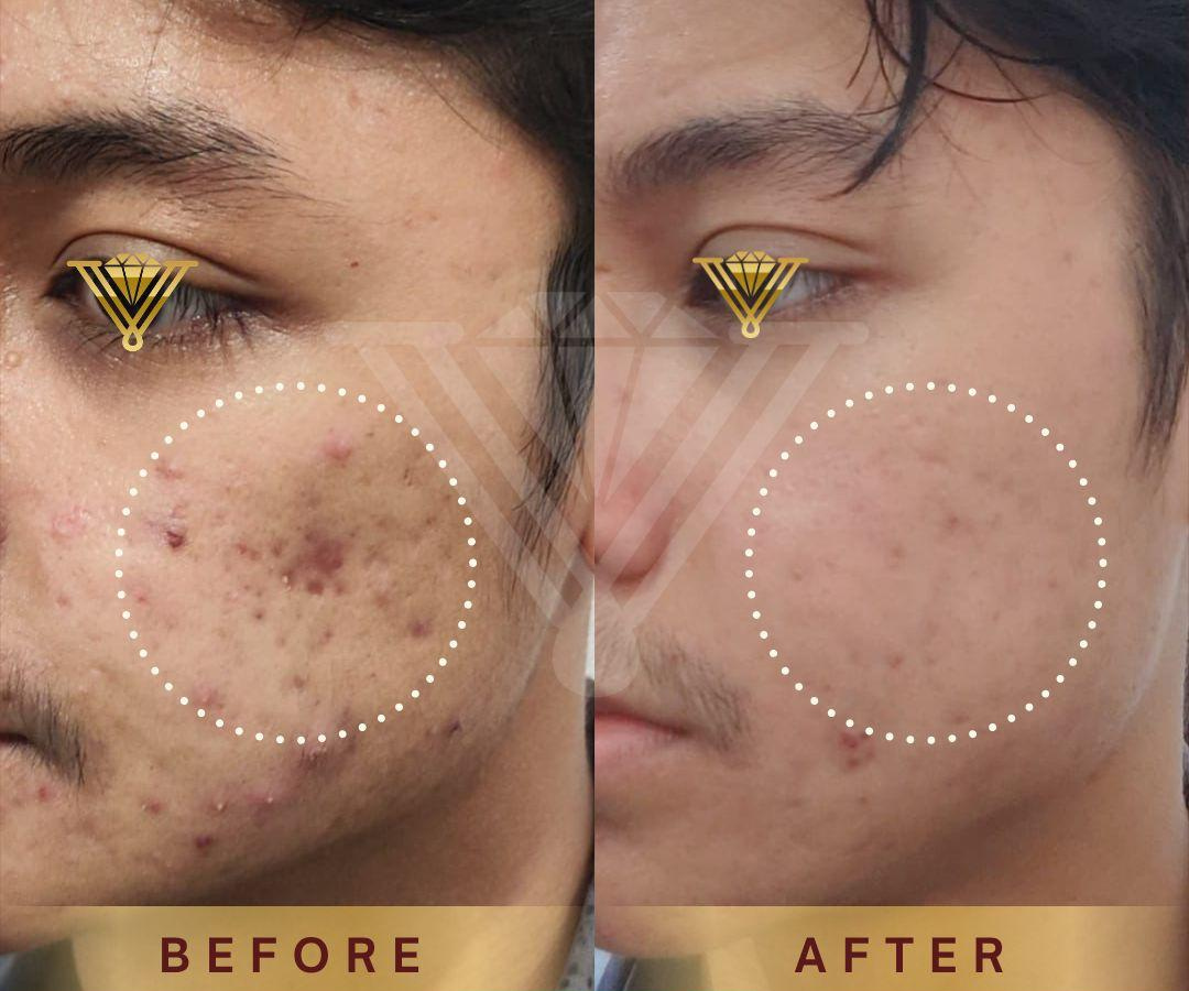 Before after Skin Booster pasien Venus Glow